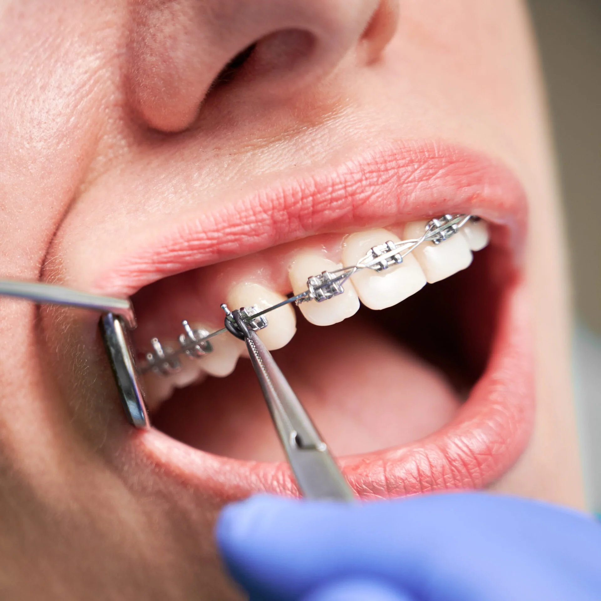 Ορθοδοντική στο Dental-i Ηλιούπολη
